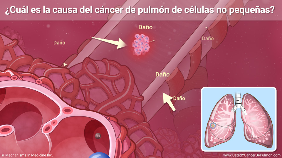 Presentaci N De Diapositivas Comprender El C Ncer De Pulm N De